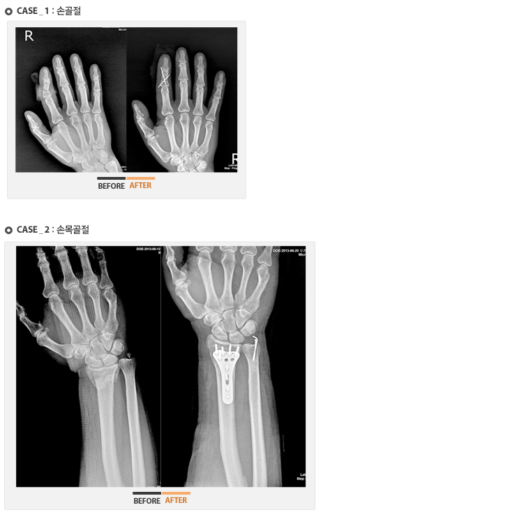 case1 - 수술 전후 사진