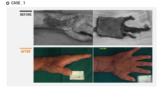 case1 - 수술 전후 사진