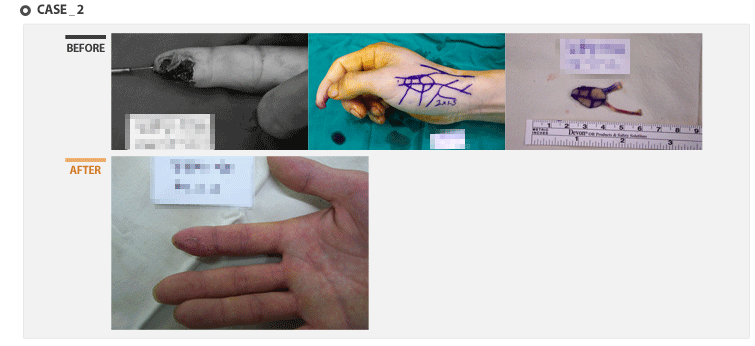 case2 - 수술 전후 사진