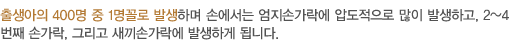 출생아의 400명 중 1명꼴로 발생하며 손에서는 엄지손가락에 압도적으로 많이 발생하고, 2~4번째 손가락, 그리고 새끼손가락에 발생하게 됩니다.