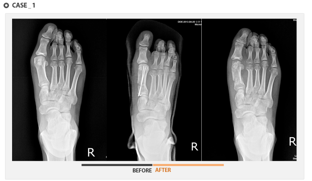 case1 - 수술 전후 사진