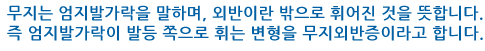 무지는 엄지발가락을 말하며, 외반이란 밖으로 휘어진 것을 뜻합니다. 즉 엄지발가락이 발등 쪽으로 휘는 변형을 무지외반증이라고 합니다.