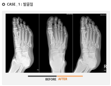 case1 - 발골절 수술 전후 사진