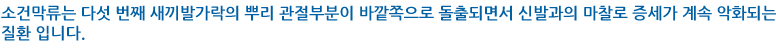 소건막류는 다섯 번째 새끼발가락의 뿌리 관절부분이 바깥쪽으로 돌출되면서 신발과의 마찰로 증세가 계속 악화되는 질환입니다.  